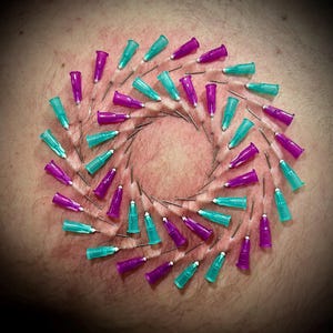May include: A close-up of a person's skin with a circular pattern of 30 small, sharp needles. The needles are arranged in a spiral pattern and are alternating colors of teal and purple.