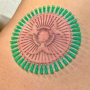 May include: A close-up of a person's back with a circular pattern of green needles inserted into the skin. The needles are arranged in a spiral pattern, with the points facing outward.