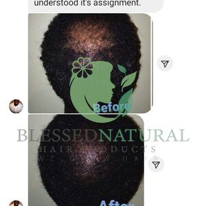 May include: Before and after photos showing the results of a hair growth product. The before photo shows a person with thinning hair on the top of their head. The after photo shows the same person with fuller hair. The product is called "Blessed Natural Hair Products".