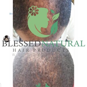 May include: A before and after photo showing hair growth. The top image shows a person's scalp with sparse hair. The bottom image shows the same person's scalp with more hair growth. The image includes the text "BLESSED NATURAL HAIR PRODUCTS WE GROW HAIR".