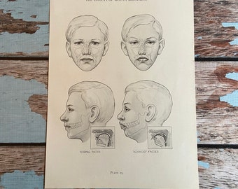 Effects of Mouth Breathing. Vintage FACE ANATOMY Medical Print. Black & White Lithograph to Frame 1952. Oral Cavity Oddity Dentist Oral