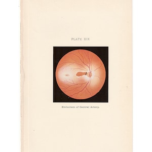 c. 1910 EYE ANATOMY print • original antique print • medical illustration • Ophthalmology • optometry • eye doctor • embolism of artery