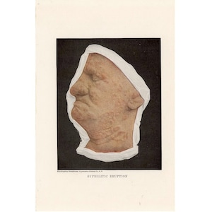 May include: A close-up of a person's face with a red rash. The image is labeled "Syphilitic Eruption".