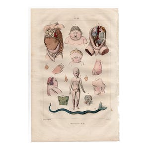 May include: A vintage anatomical illustration depicting various human body parts with deformities. The illustration is in color and includes a snake, a foot, a hand, and several heads.