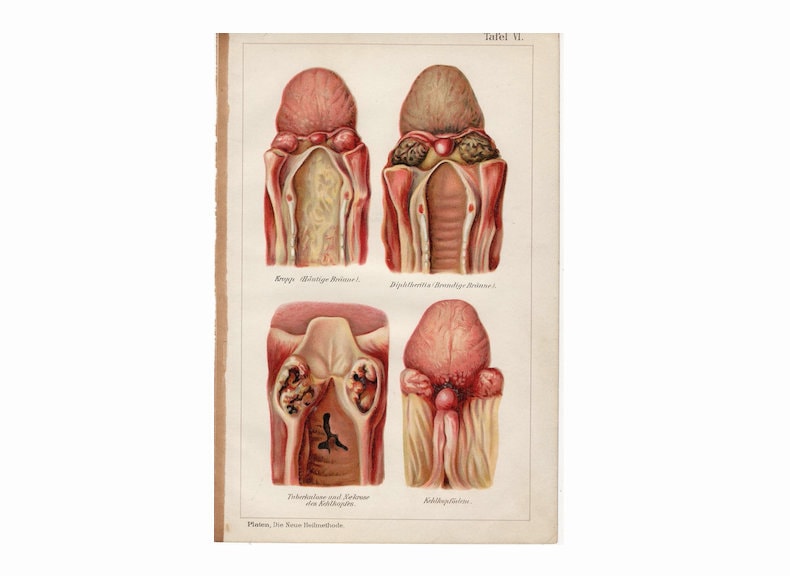 c.1902 THROAT DISEASE print - antique human anatomy print - larynx anatomy - laryngeal edema - necrosis of the larynx - diphtheria
