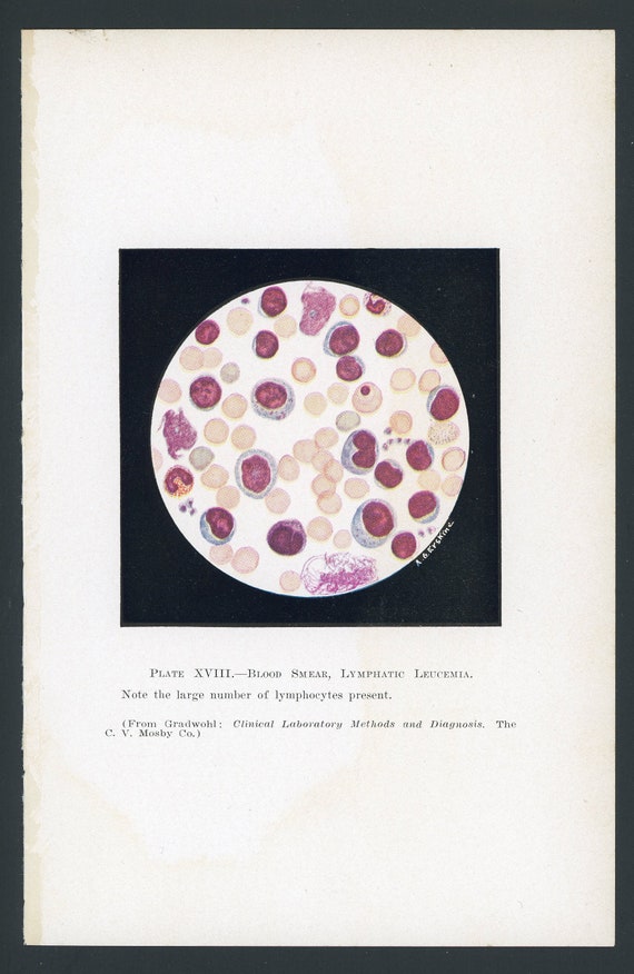C. 1939 SOUS LE MICROSCOPE lithographie frottis sanguin de leucémie  impression vintage originale microbiologie hématologie hématologue - Etsy  France