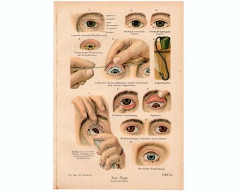 c. 1921 EYE ANATOMY and DISEASE lithograph • original antique print • medical illustration • human anatomy original