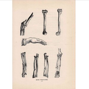 1903 HUMAN ANATOMY BONES original antique anatomy print of bone fractures