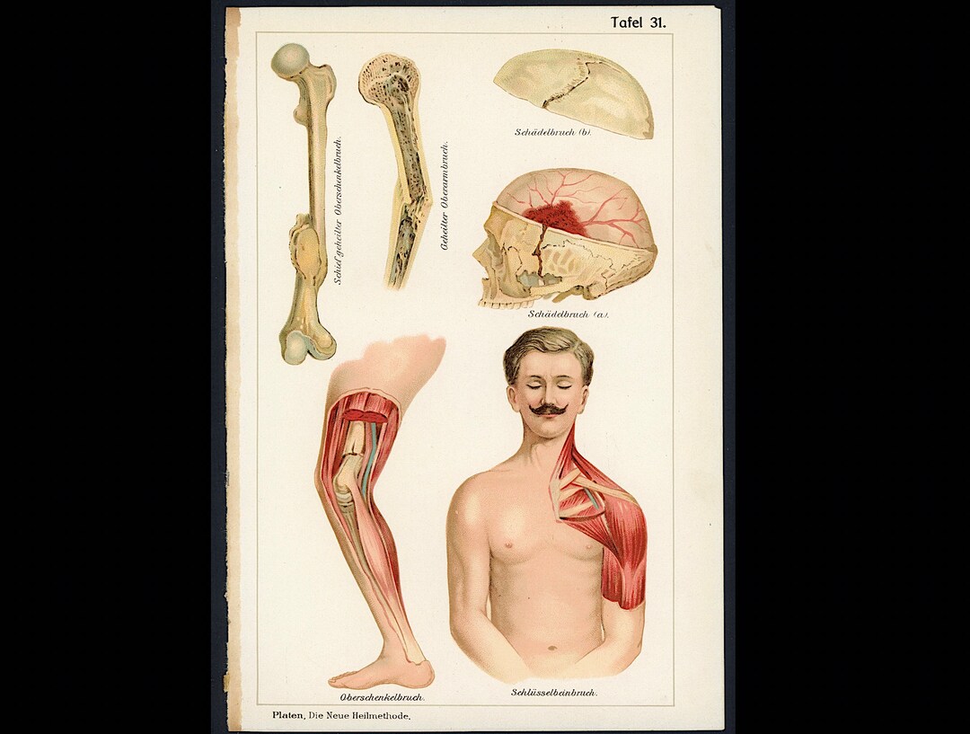 C. 1902 BONES Lithograph • Original Antique Print • Bone Damage ...
