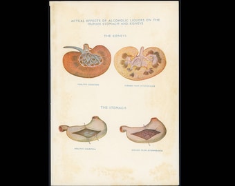 c. 1926 EFFECT of ALCOHOL print • on human organs • original antique print • medical print • liver disease • alcoholism print