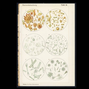 c. 1902 URINALYSIS lithograph • original antique print • microscopic view • medical laboratory • microscopic cells • urine crystals • debris