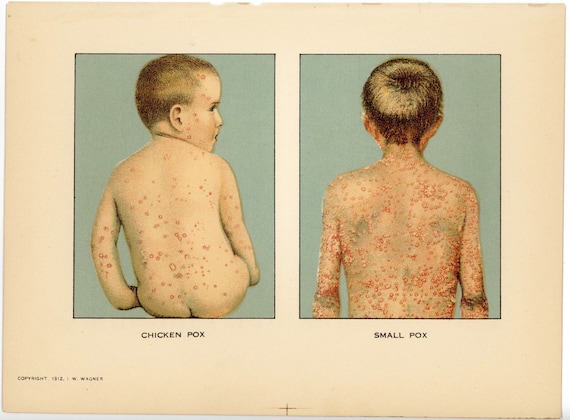 Smallpox Keep Out Smallpox Plague