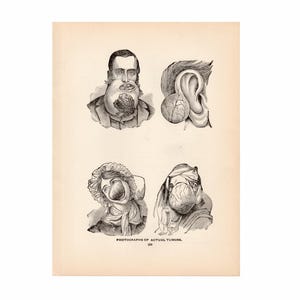 c. 1901 TUMOR ANATOMY print • original antique print • medical illustration • human anatomy print • drawings of real tumors