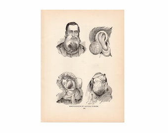 c. 1901 TUMOR ANATOMY print • original antique print • medical illustration • human anatomy print • drawings of real tumors