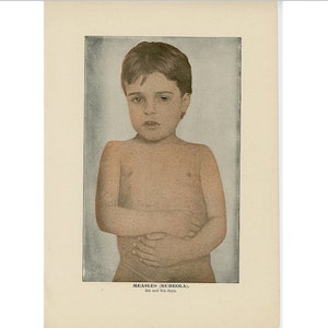 1906 MEASLES print - original antique medical print - human anatomy - skin disease print - rubela - childhood disease