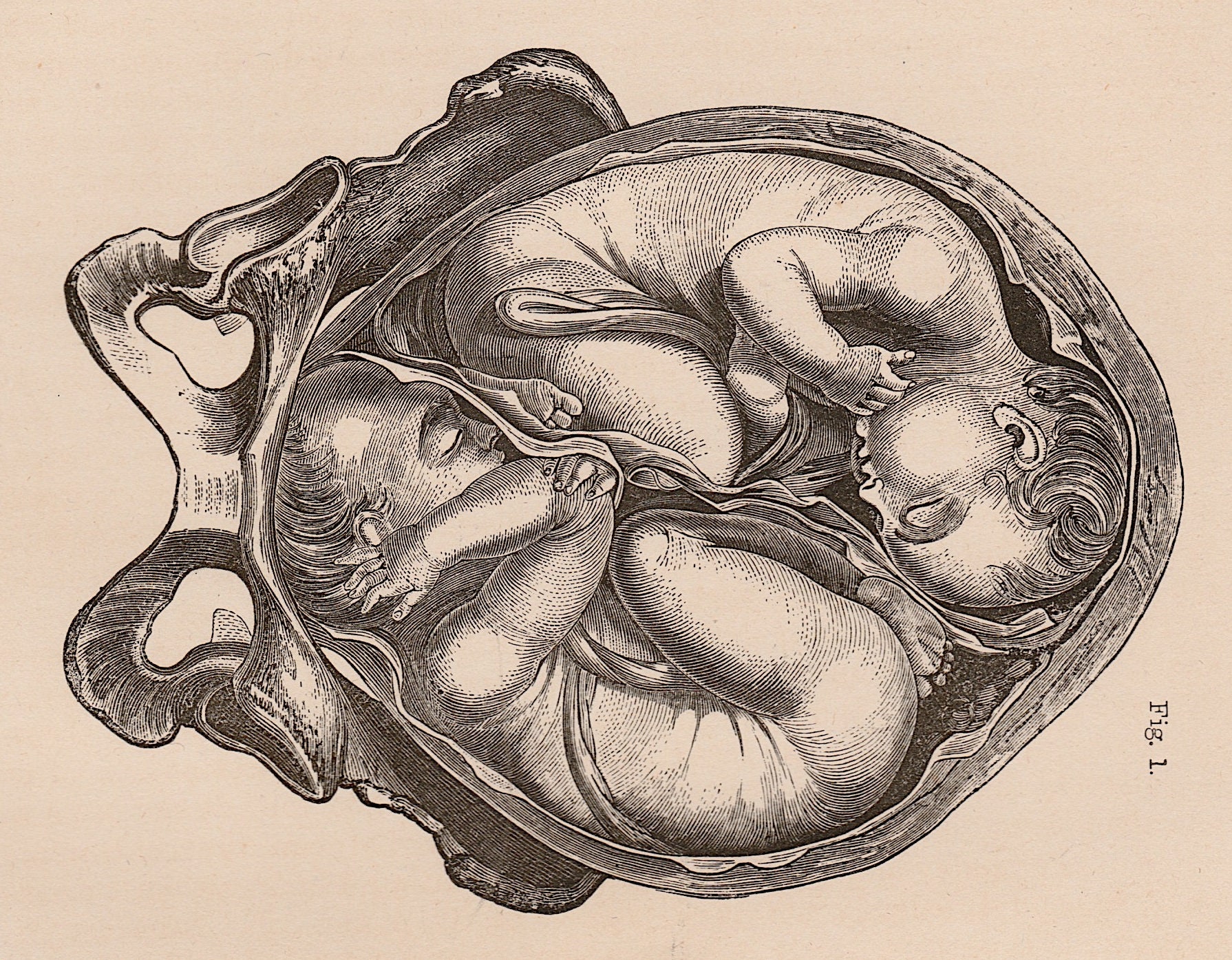 C. 1860 TWINS IN WOMB Lithograph • Original Antique Print