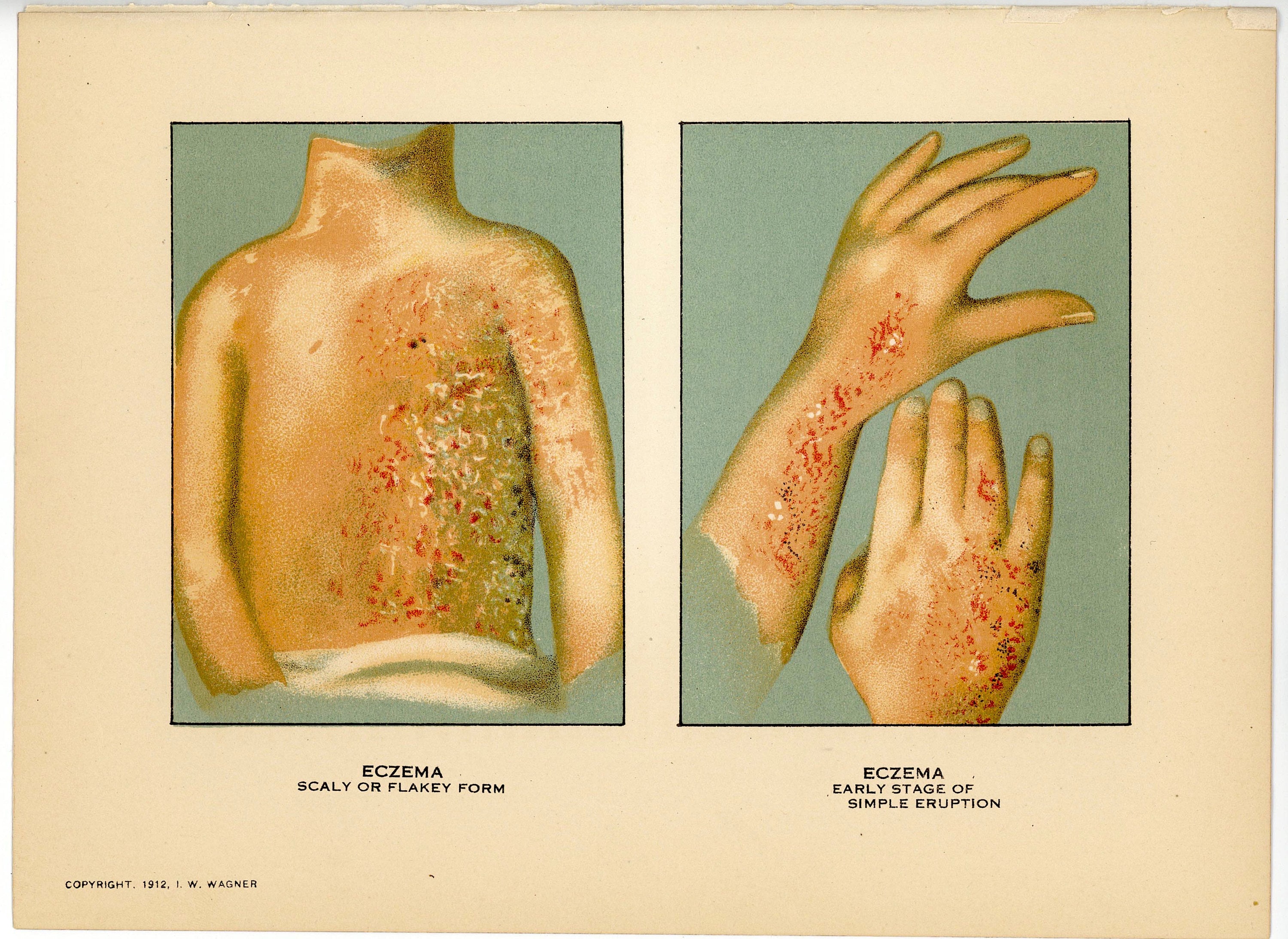c. 1912 ECZEMA lithograph • original antique print • skin disease • medical condition print • dermatology print • eczematous dermatitis