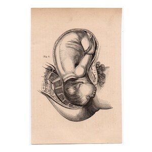 c. 1860 BABY IN WOMB lithograph • original antique print • fetus anatomy • pregnant mother • in utero • birthing print • Mother&#39;s Day gift