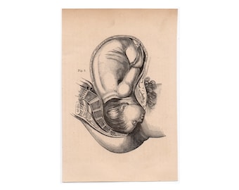 BABY IN WOMB Lithograph C. 1860 • Original Antique Print • Fetus
