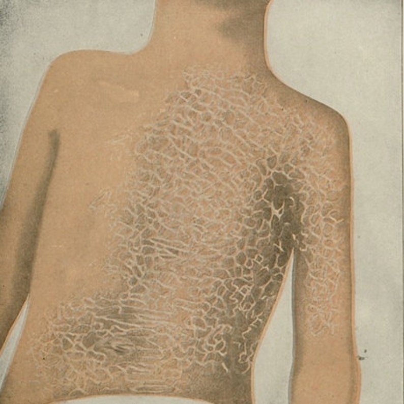 1906 ECZEMA SKIN DISEASE scaly and simple forms human anatomy original antique skin disease print image 2