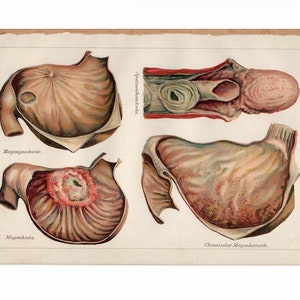 c.1902 - STOMACH DISEASE print - original antique human anatomy print - stomach anatomy - ulcer - stomach cancer - gastritis