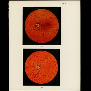 c. 1922 EYE ANATOMY lithograph • original antique print • eye print • medical illustration • eyeball • ophthalmology • under opthalmoscope