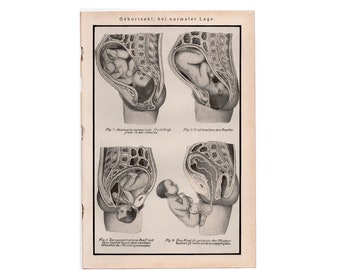 BIRTHING POSITIONS antique print c. 1929 - original antique lithograph • medical print - pregnancy - pregnant woman - baby in womb