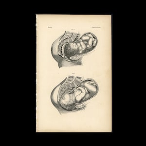 c. 1860 BABY IN WOMB lithograph • original antique print • fetus anatomy • pregnant mother • in utero • birthing print • Mother&#39;s Day gift