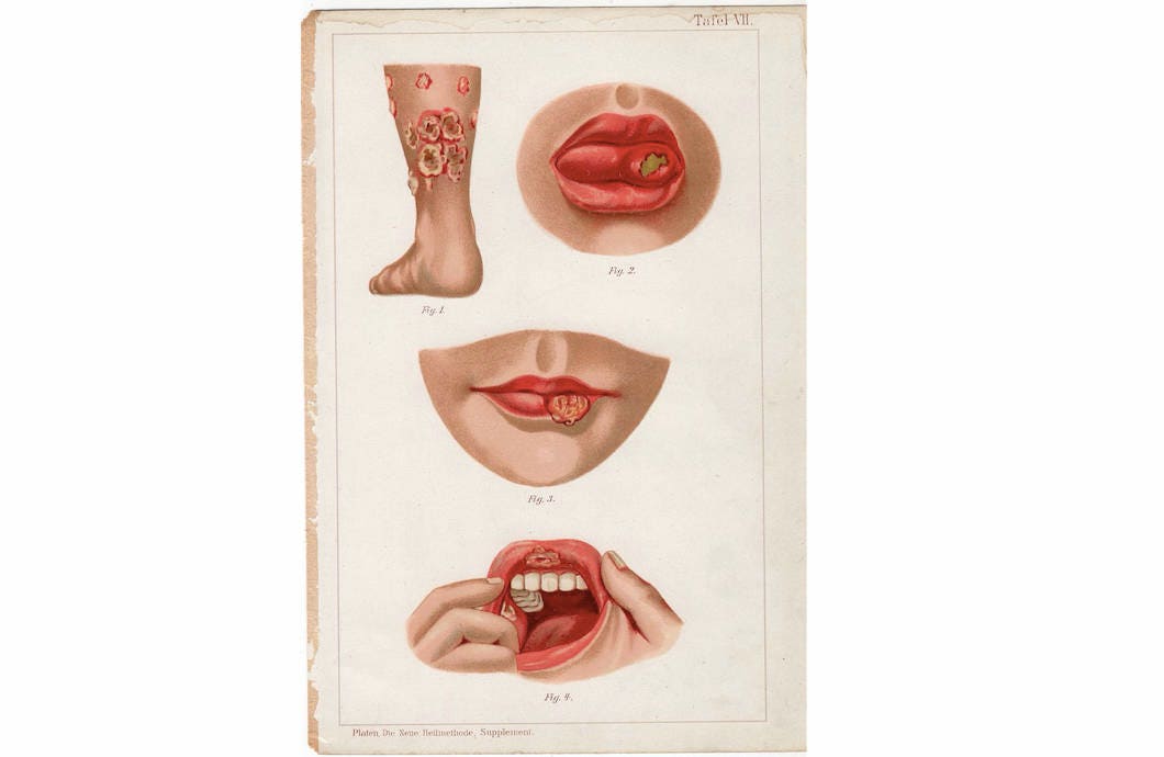 C. 1902 Litografía de ENFERMEDADES DE LA PIEL Y LA BOCA - sífilis, úlcera, placa mucoide • litografía de anatomía humana - impresión antigua - impresión dermatológica