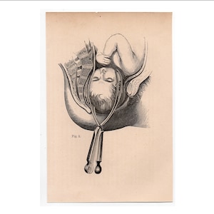 c. 1860 BABY IN WOMB lithograph • original antique print • fetus anatomy • pregnant mother • in utero • birthing print • Mother&#39;s Day gift