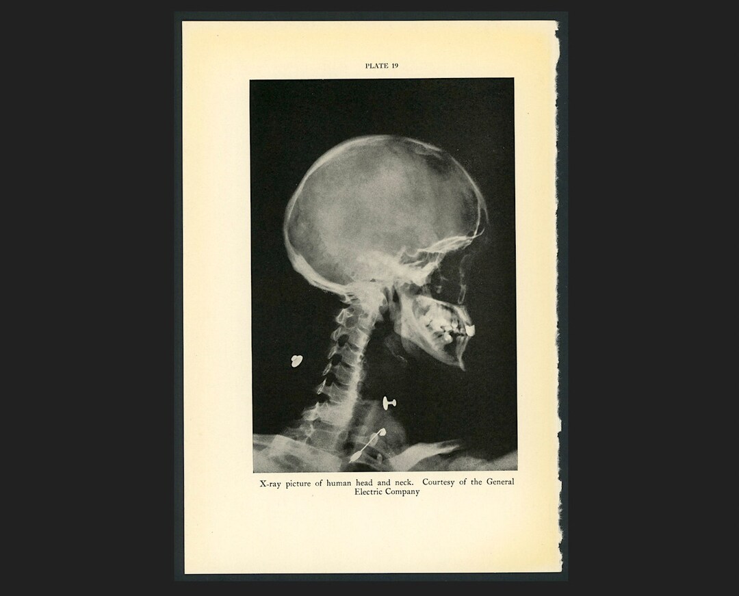 C. 1934 X-RAY HEAD &amp; NECK Lithograph Original Vintage Print Human ...