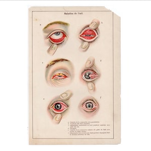 c 1900 AUGEN KRANKHEITEN Lithographie • original antique Druck von menschlichen Augapfel Anatomie Druck - Augenheilkunde Druck - menschliche Anatomie