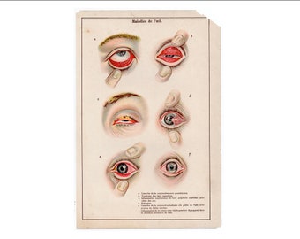 EYE DISEASES lithograph c 1900 •  original antique print of human eyeball anatomy print - Ophthalmology print - human anatomy print