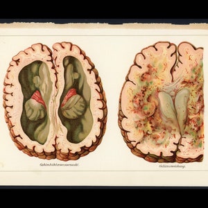 c. 1902 BRAIN ANATOMY lithograph • original antique print • human anatomy - stroke - encephalitis - edema - nervous system - brain disease