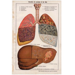 H. 1902 LUNGE & LEBER ERKRANKUNG Druck original antike Anatomie Lithographie - Krankheiten der Lunge und der Leber