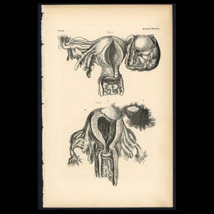 c. 1860 ECTOPIC PREGNANCY lithograph • original antique print • fetus anatomy • Mother&#39;s Day gift • pregnant mother • in utero •