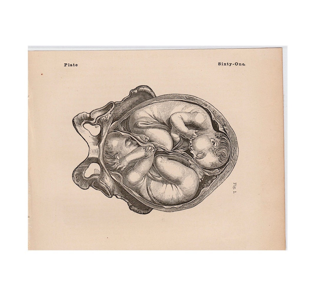 C. 1860 TWINS IN WOMB Lithograph • Original Antique Print