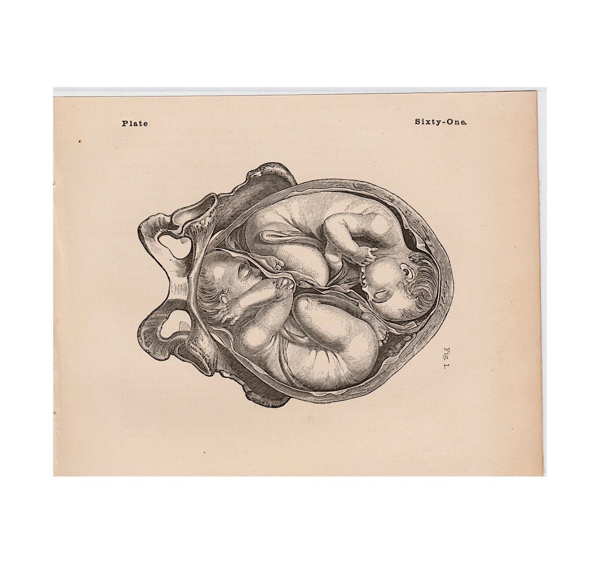 絵画 the memory in the womb C. 1860 TWINS IN WOMB Lithograph • Original Antique Print