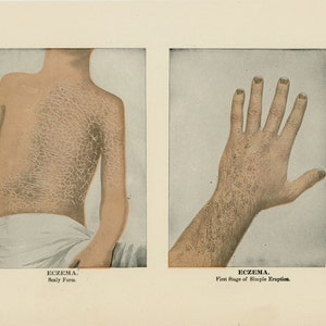 1906 ECZEMA SKIN DISEASE scaly and simple forms human anatomy original antique skin disease print image 1