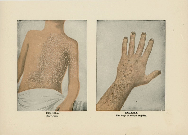 1906 ECZEMA SKIN DISEASE scaly and simple forms human anatomy original antique skin disease print image 1