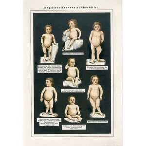ca. 1900 - CHILDHOOD DISEASES Print - original antiken Druck - menschliche Anatomie - Medizin Drucke - Geschichte der Krankheiten - Krankheit