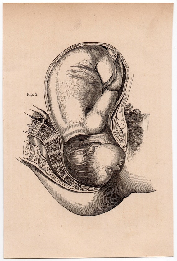 C. 1860 BABY IN WOMB Lithograph • Original Antique Print • Fetus