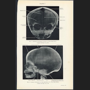 c. 1937 FETUS SKULLS lithograph • original vintage print • fetal anatomy • Mother&#39;s Day • pregnant mother • childbirth • fœtus skeleton