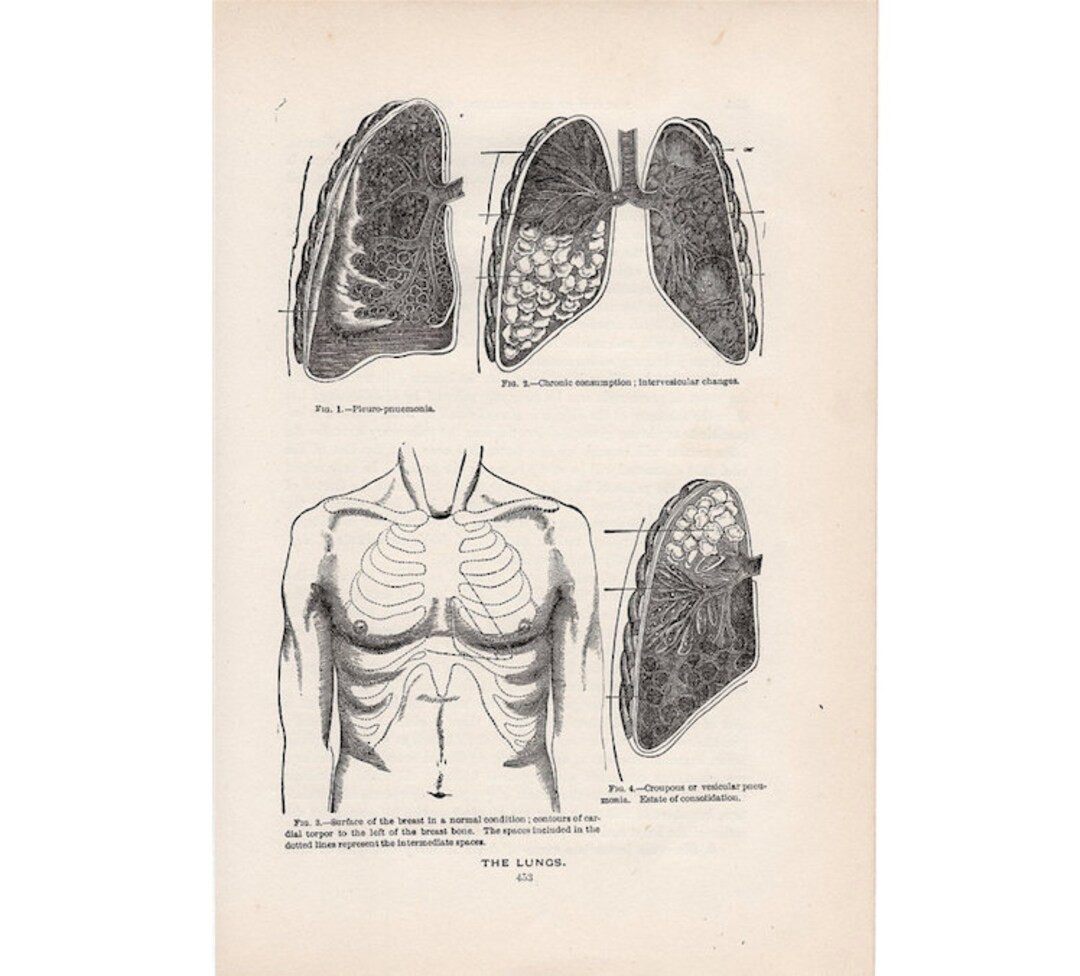 LUNGS ANATOMY Antique Print C. 1901 • Original Antique Lithograph ...