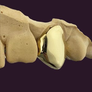 Könnte beinhalten: Ein Zahnmodell mit einer Goldkrone. Die glänzende Krone reflektiert das Licht und bildet einen Kontrast zu der beigen Farbe der umliegenden Zähne. Der Hintergrund ist dunkelviolett.