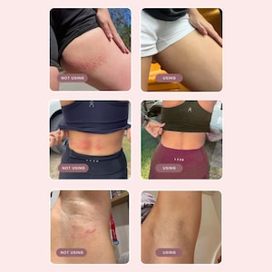 May include: A comparison grid showing skin conditions labelled NOT USING and USING. The left column displays skin with red irritation, rashes, or marks on the thigh, lower back, and underarm. The right column shows clear, smooth skin in the same areas.