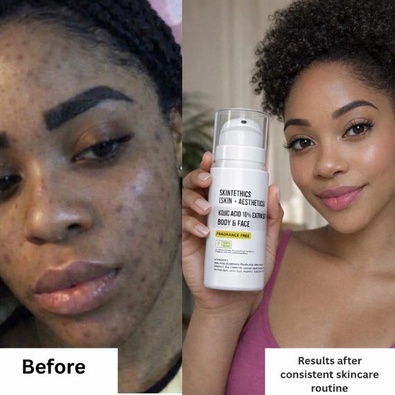 Kojic Acid 10% Extra Strength Body and Face Cream - Etsy