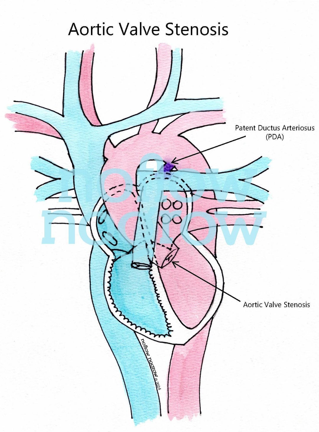 Aortic Valve Stenosis Watercolor Illustration Etsy