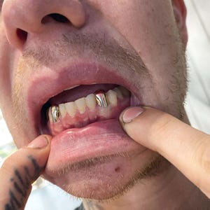 Solid Gold Caps 10K Gold, 18K Gold & Dental Gold Custom Made Grillz Any Teeth FREE Mould Kit!