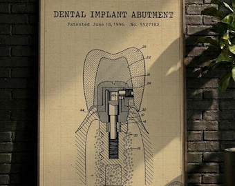 PÓSTER / Decoración de pared, Lámina de patente de pilar de implante dental, Póster de plano vintage (Descarga digital)